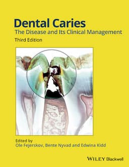 Dental Caries: The Disease and its Clinical Management, 3rd Edition