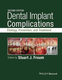 Dental Implant Complications: Etiology, Prevention, and Treatment, 2nd Edition