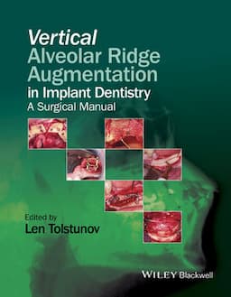 Vertical Alveolar Ridge Augmentation in Implant Dentistry: A Surgical Manual