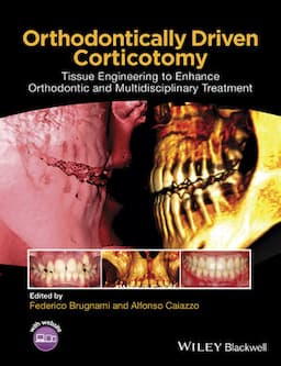 Orthodontically Driven Corticotomy: Tissue Engineering to Enhance Orthodontic and Multidisciplinary Treatment