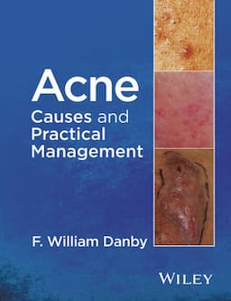 Acne: Causes and Practical Management