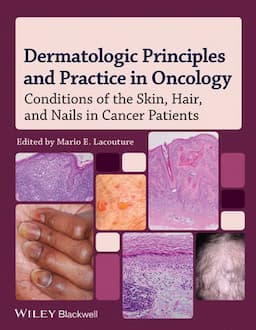 Dermatologic Principles and Practice in Oncology: Conditions of the Skin, Hair, and Nails in Cancer Patients