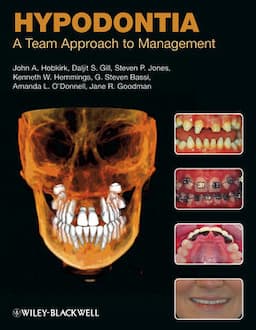 Hypodontia: A Team Approach to Management